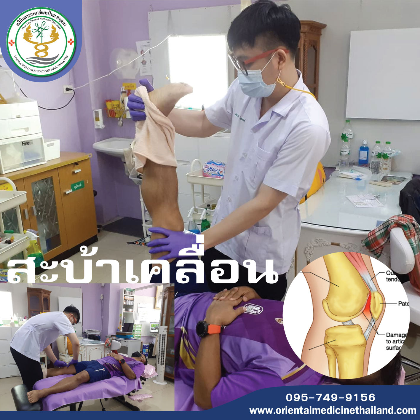 สะบ้าเคลื่อน สะบ้าหลุด หรือ ข้อเข่าเคลื่อนหลุด (dislocation)