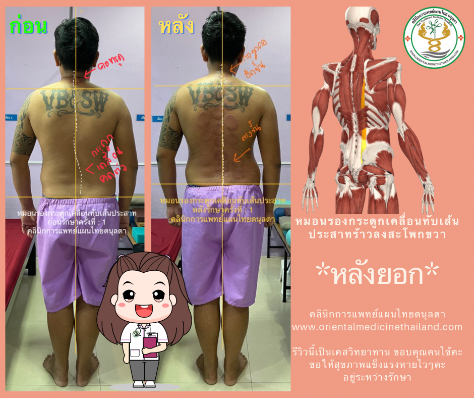 1-รีวิว คลินิกแผนไทยรักษาหมอนรองกระดูกทับเส้นประสาทปวดร้าวลงสะโพกขวา โสธรสหคลินิก หมอหนูนวดจัดกระดูก